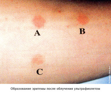 Образование эритемы после облучения ультрафиолетом.